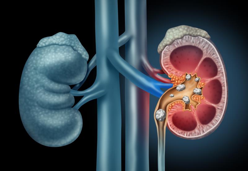 Secondary kidney stones: to remove or not?