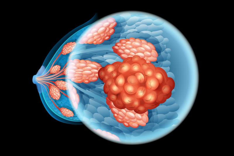 Benefits of 1L ribociclib extend across MONALEESA studies