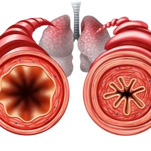 Benralizumab reduces asthma exacerbation rates in real-world setting