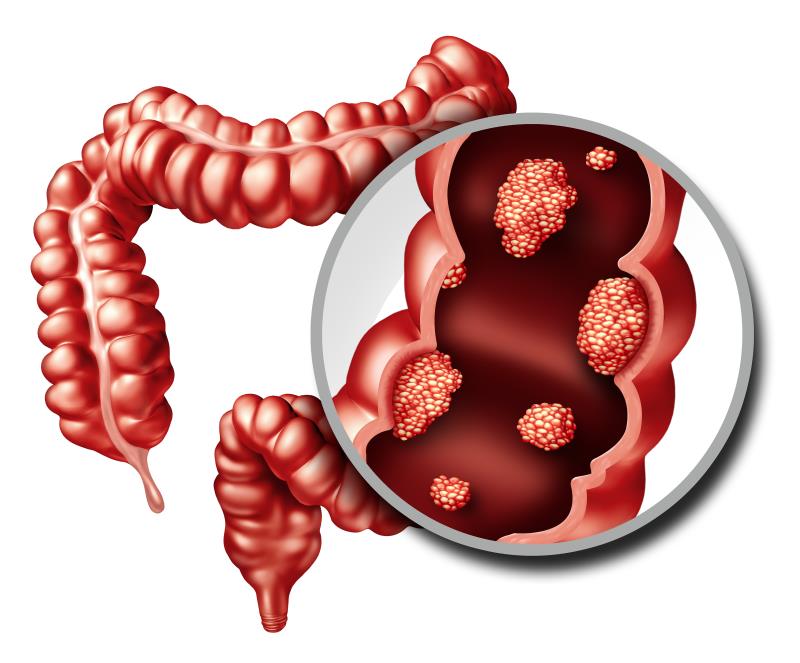 Berberine cuts risk of recurrent colorectal polyp