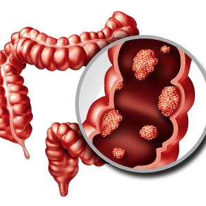 Advanced adenomas, large serrated polyps predict CRC risk after endoscopy