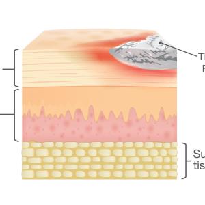 Bimekizumab maintains skin clearance in patients with plaque psoriasis