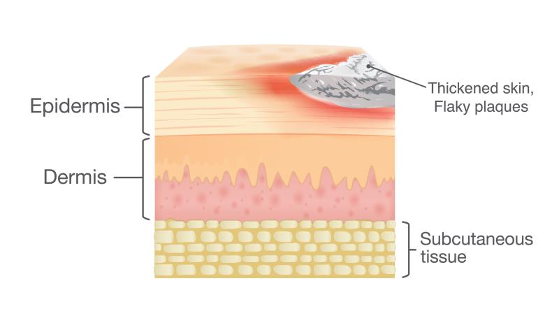 Bimekizumab maintains skin clearance in patients with plaque psoriasis