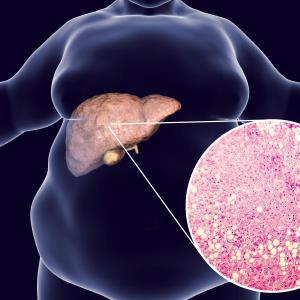 Muscle fat content linked to nonalcoholic steatohepatitis