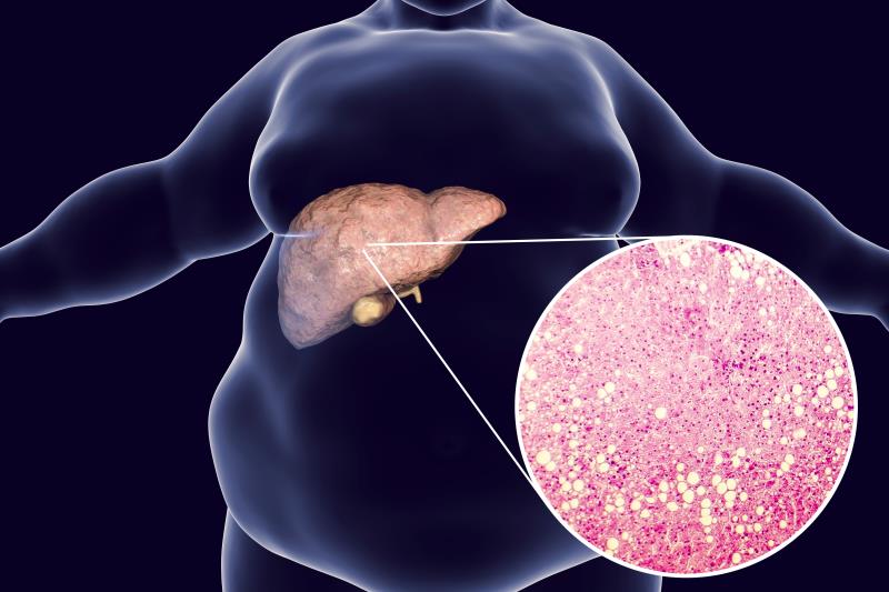 Muscle fat content linked to nonalcoholic steatohepatitis