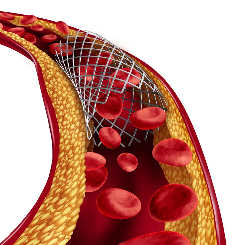 Timing of stent thrombosis does not affect mortality risk