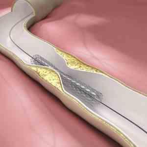 Bioresorbable scaffolds open up new possibilities in PCI