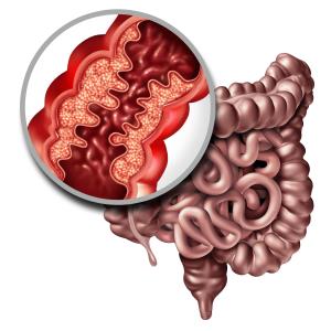 Higher postinduction infliximab concentrations tied to improved outcomes in fistulizing CD