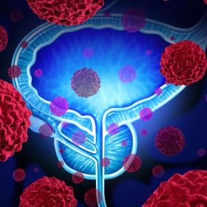 Atezolizumab may prolong survival in bladder cancer