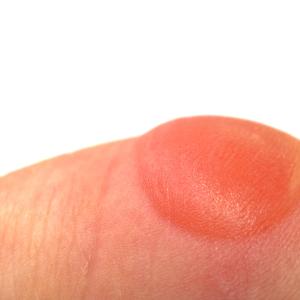 Low-dose IL-2 therapy safe, effective in moderate-to-severe bullous pemphigoid