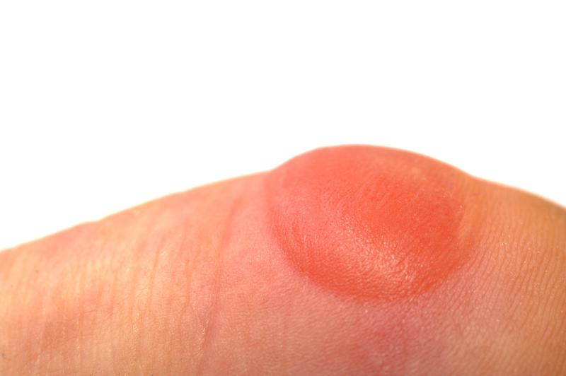 Low-dose IL-2 therapy safe, effective in moderate-to-severe bullous pemphigoid