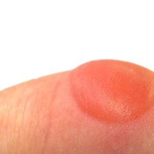 Dupilumab shows promise in bullous pemphigoid