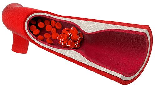 Immune-mediated diseases carry increased risk of thromboembolic events