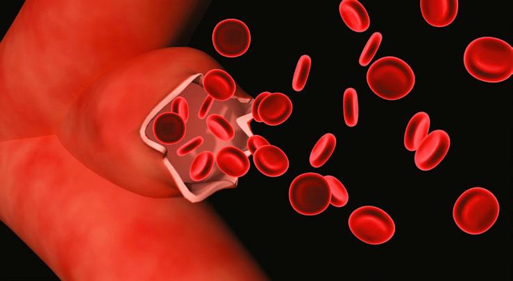 Rusfertide stabilizes haematocrit for 2.5 years in PCV