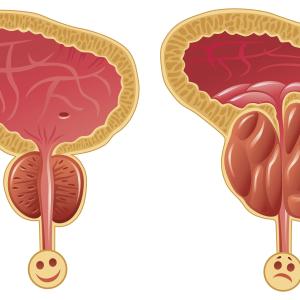 Less is more when treating benign prostatic hyperplasia with thermal water vapour