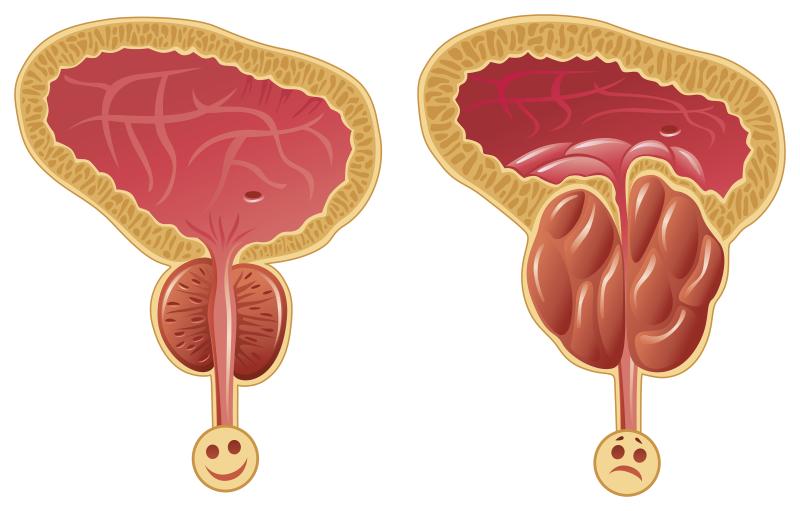 Less is more when treating benign prostatic hyperplasia with thermal water vapour