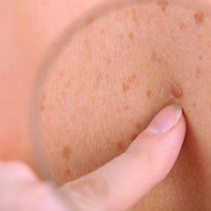 Valproic acid may be protective against melanoma