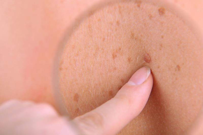 Valproic acid may be protective against melanoma