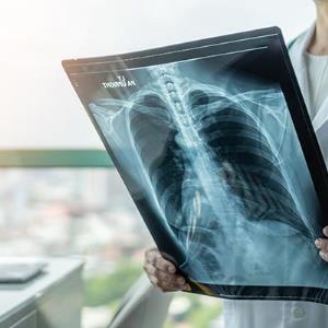 Broaden screening in patients with TB or HBV, says study