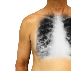 Brensocatib for bronchiectasis delivers in phase II trial