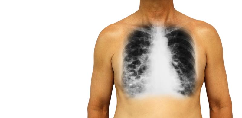 Brensocatib for bronchiectasis delivers in phase II trial