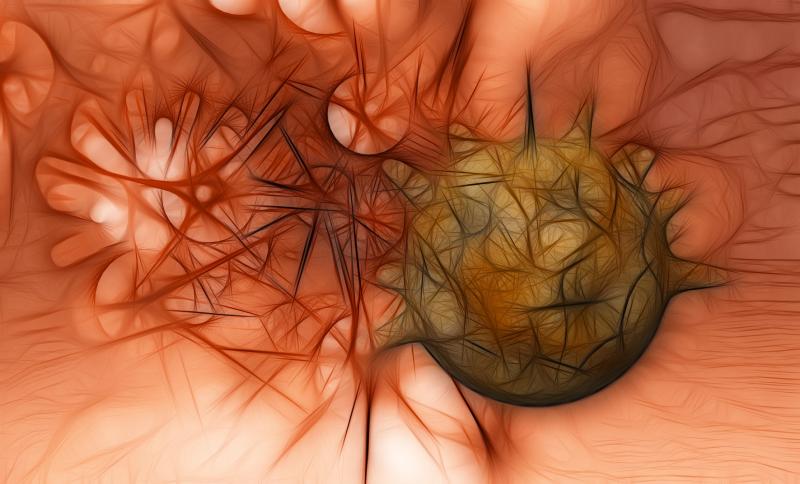 Cell-cycle progression tied to metastasis-free survival in high-risk prostate cancer