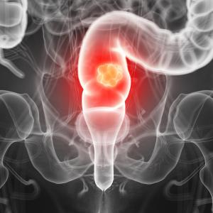 Acid suppression therapy plus capecitabine may lower survival in colorectal cancer patients