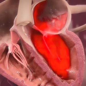 Septal LGE predicts major ventricular arrhythmia, cardiac death in cardiomyopathy