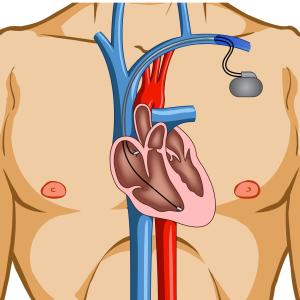 Selective aldose reductase inhibitor for DCM disappoints in trial