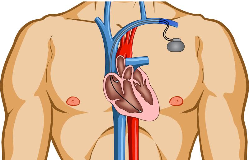 Selective aldose reductase inhibitor for DCM disappoints in trial