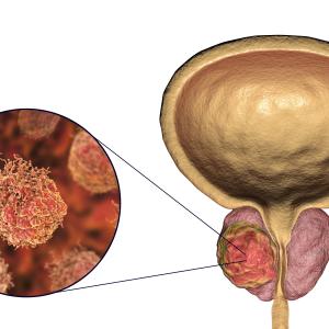 Chronic inflammation tied to lower tumour grade in prostate cancer