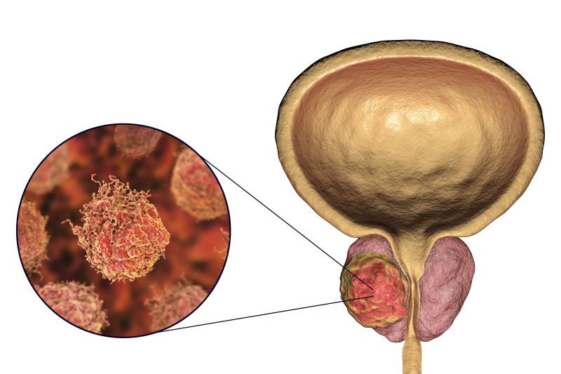 Chronic inflammation tied to lower tumour grade in prostate cancer