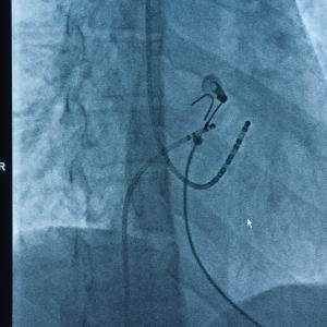 Catheter ablation lowers atrial fibrillation recurrence, burden