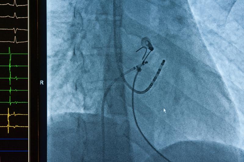 Catheter ablation lowers atrial fibrillation recurrence, burden