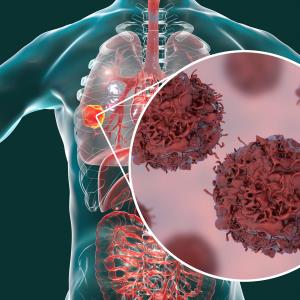 Cemiplimab prolongs survival in advanced NSCLC with high PD-L1 expression