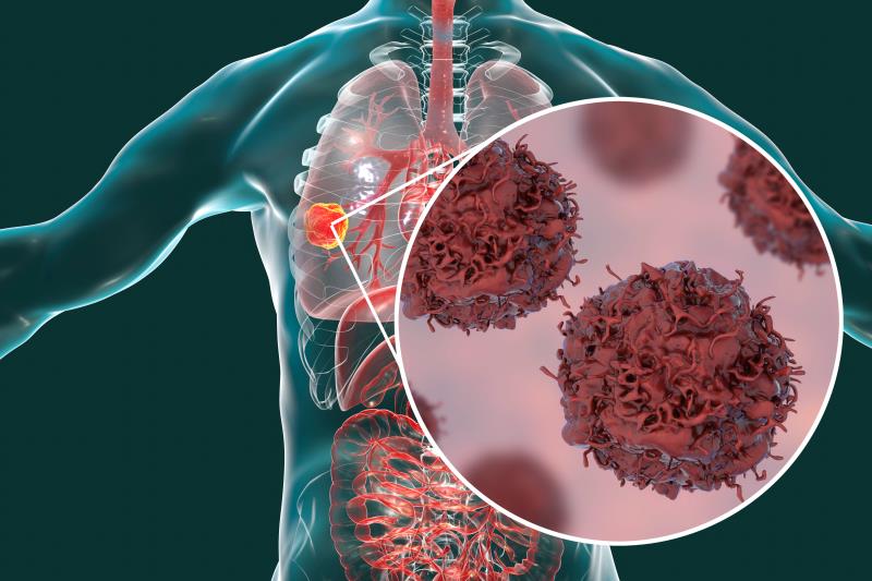 Cemiplimab prolongs survival in advanced NSCLC with high PD-L1 expression