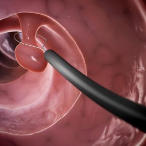 Endoscopic submucosal dissection safer, more cost-effective than transanal endoscopic microsurgery