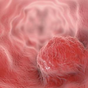 Frontline nivolumab plus chemo or ipilimumab maintains OS benefit in advanced ESCC