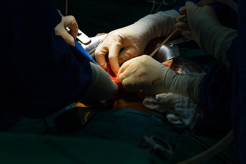 Chemo plus liver transplant prolongs survival in unresectable colorectal liver metastases