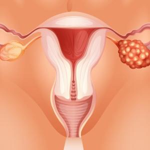 Bevacizumab-trabectedin combo safe, effective in recurrent ovarian cancer