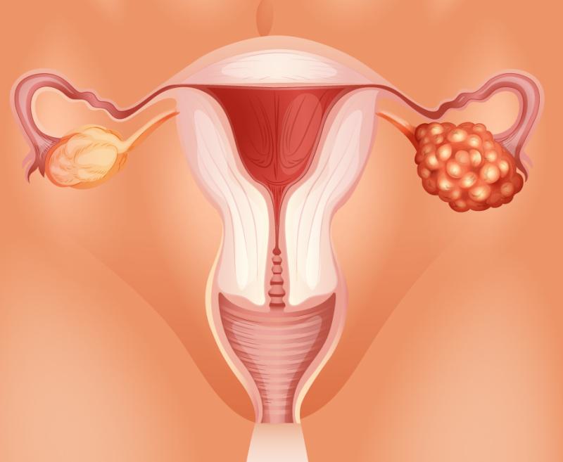 Bevacizumab-trabectedin combo safe, effective in recurrent ovarian cancer