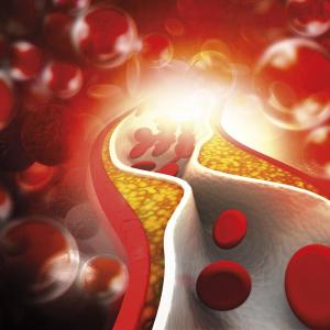 Study finds care gap in patients with familial hypercholesterolemia