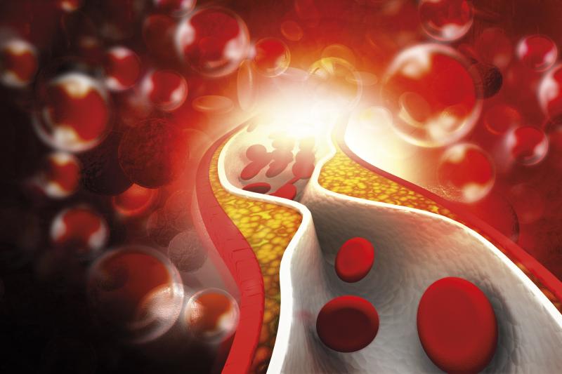 Study finds gap in care of patients with familial hypercholesterolaemia