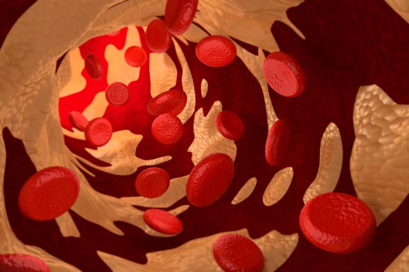 Stem cells have been found to be responsible for calcification in arteries of patients with chronic kidney disease