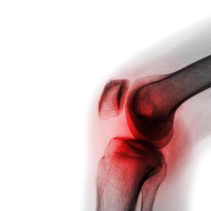 OKINADA: TNF inhibition disappoints in knee osteoarthritis