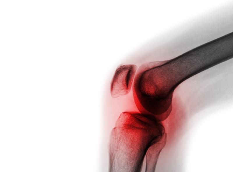 OKINADA: TNF inhibition disappoints in knee osteoarthritis