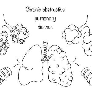 Chronic bronchitis symptoms hint at benefits of mepolizumab in COPD with T2 inflammation
