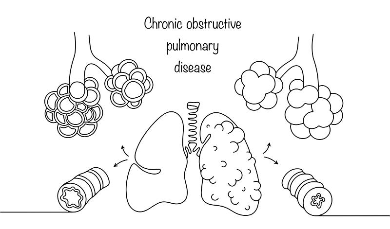 Chronic bronchitis symptoms hint at benefits of mepolizumab in COPD with T2 inflammation