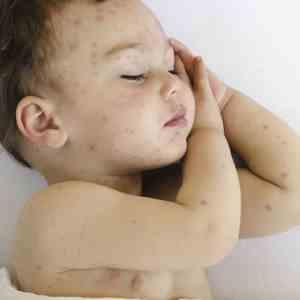 Clues to help manage pediatric skin infections