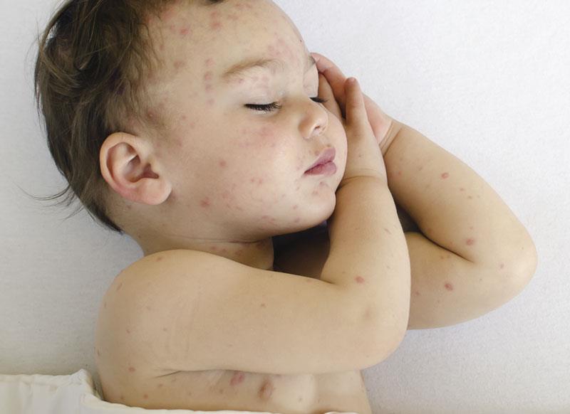 (JM country specific)Clues to help manage pediatric skin infections